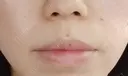 ボトックス（口角） YBC横浜美容外科 大宮院 DAY 43 サムネイル用