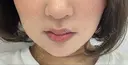 ニードルRF（ポテンツァなど） ゆう美容クリニック DAY 10 サムネイル用