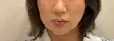 ニードルRF（ポテンツァなど） ゆう美容クリニック AFTER サムネイル用