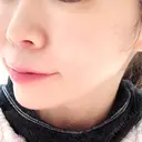 ヒアルロン酸注入（あご） TCB東京中央美容外科 世田谷院 AFTER サムネイル用