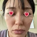 光治療（フォトフェイシャルなど） APOLLO BEAUTY CLINIC DAY 9 サムネイル用