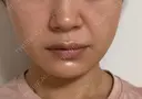 糸リフト / ヒアルロン酸注入（あご） ブルームクリニック（BLOOM CLINIC） DAY 59 サムネイル用