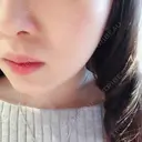 脂肪溶解注射（顔） S Beauty Clinic DAY 50 サムネイル用
