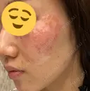 シミ取りレーザー CLINICA BellaForma DAY 0 サムネイル用