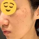 シミ取りレーザー CLINICA BellaForma DAY 2 サムネイル用