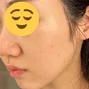 シミ取りレーザー CLINICA BellaForma AFTER サムネイル用