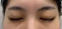 その他（目元） / 上まぶたの脂肪取り 9BeautyClinic DAY 2 サムネイル用