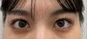 その他（目元） / 上まぶたの脂肪取り 9BeautyClinic DAY 5 サムネイル用