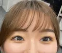 二重埋没 / 目頭切開 9BeautyClinic DAY 31 サムネイル用