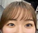 二重埋没 / 目頭切開 9BeautyClinic AFTER サムネイル用