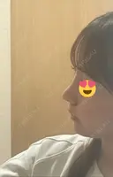 鼻尖形成（切開） / 小鼻縮小（切開） / 軟骨移植 / 鼻柱下降・鼻唇角形成（猫手術） / ヒアルロン酸注入（あご） グローバルビューティークリニック 東京院 DAY 7 サムネイル用