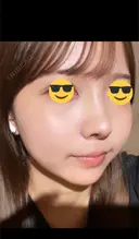 鼻尖形成（切開） / 小鼻縮小（切開） / 軟骨移植 / 鼻柱下降・鼻唇角形成（猫手術） / ヒアルロン酸注入（あご） グローバルビューティークリニック 東京院 DAY 7 サムネイル用