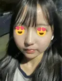 鼻尖形成（切開） / 小鼻縮小（切開） / 軟骨移植 / 鼻柱下降・鼻唇角形成（猫手術） / ヒアルロン酸注入（あご） グローバルビューティークリニック 東京院 DAY 16 サムネイル用