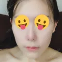 骨切り（あご） / 脂肪吸引（顔） / セットバック / ルフォー+ssro（両あご) リッツ美容外科 東京院 DAY 21 サムネイル用