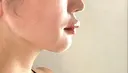 人中短縮 / ヒアルロン酸注入（唇） / ボトックス（口角） DMTC CLINIC 日本橋院 DAY 12 サムネイル用