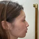 ボトックス（タレ目） / ボトックス（人中） / ボトックス（ガミースマイル） TCB東京中央美容外科 長崎院 AFTER サムネイル用