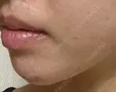 ヒアルロン酸注入（あご） / ヒアルロン酸注入（額） / ボトックス（眉間） / ピコレーザートーニング（美白・肝斑） THE FIRST CLINIC 多摩センター院 DAY 0 サムネイル用