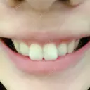 ガミースマイル手術 / その他（審美歯科/矯正歯科） / その他（口元） 有楽町美容外科クリニック DAY 1 サムネイル用