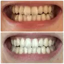 ホワイトニング / その他（審美歯科/矯正歯科） 池袋麗歯科・美容皮膚科 AFTER サムネイル用