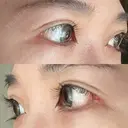 目尻切開 / タレ目形成・グラマラスライン（切開） 銀座高須クリニック DAY 30 サムネイル用