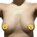 豊胸（脂肪注入） 湘南美容クリニック 那覇院 AFTER サムネイル用