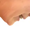 脂肪溶解注射（顔） TCB東京中央美容外科 千葉駅前院 BEFORE サムネイル用