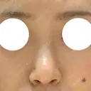 鼻尖形成（切開） / 軟骨移植 / 眉間プロテーゼ 湘南美容クリニック 神戸院 BEFORE サムネイル用