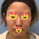 ピーリング（ニキビ・毛穴） / ダーマペン 表参道スキンクリニック 名古屋院（DAILY SKIN CLINIC提携院） BEFORE サムネイル用