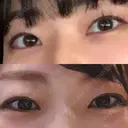二重切開 松下皮フ形成外科 BEFORE サムネイル用