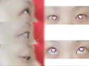 目尻切開 / 目尻靭帯移動 FROM B整形外科 (旧バウム整形外科) BEFORE サムネイル用