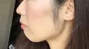 あごプロテーゼ / 鼻翼基部形成（貴族手術） ジョウクリニック 大阪院 BEFORE サムネイル用