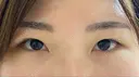 二重切開 / 上まぶたの脂肪取り 松下皮フ形成外科 BEFORE サムネイル用