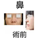 鼻尖形成（切開） / 鼻中隔延長（切開） / 軟骨移植 eクリニック 金沢本院 BEFORE サムネイル用