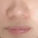 小鼻縮小（切開） ながしまクリニック BEFORE サムネイル用