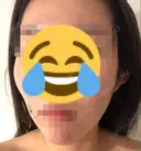 脂肪注入（輪郭） 湘南美容クリニック 新潟院 BEFORE サムネイル用
