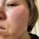 ダーマペン / 毛穴洗浄（ハイドラフェイシャルなど） B-LINE CLINIC 池袋院 BEFORE サムネイル用