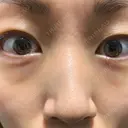 クマ治療 / 脂肪注入（肌） MIL CLINIC OSAKA BEFORE サムネイル用
