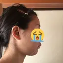 脂肪吸引（顔） ヴェルトラクリニック 大阪院 BEFORE サムネイル用