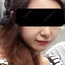 脂肪吸引（顔） / その他（輪郭） / 脂肪注入（輪郭） ヴィヴェンシアクリニック BEFORE サムネイル用