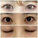 二重切開 / 上まぶたたるみ取り 城本クリニック 姫路院 BEFORE サムネイル用
