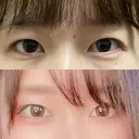 二重埋没 / 自然癒着法 シンデレラ＆ダヴィンチクリニック BEFORE サムネイル用