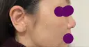 軟骨移植 フェアクリニック川口 BEFORE サムネイル用