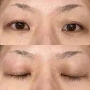 二重埋没 / 自然癒着法 シンデレラ＆ダヴィンチクリニック BEFORE サムネイル用
