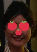 脂肪吸引（顔） / 切開リフト / ヒアルロン酸注入（ほうれい線） 東京エビスクリニック BEFORE サムネイル用