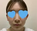 光治療（フォトフェイシャルなど） アムルーズ美容外科クリニック 大阪院 BEFORE サムネイル用