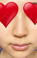 ヒアルロン酸注入（鼻） 新宿ビューティークリニック 新宿院 BEFORE サムネイル用