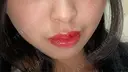 あごプロテーゼ 北尾クリニック BEFORE サムネイル用