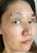 ダーマペン / 毛穴洗浄（ハイドラフェイシャルなど） AURORA CLINIC（オーロラクリニック）新宿院 BEFORE サムネイル用