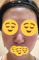 ほくろ・いぼ切除（肌） / その他（肌） / 美肌レーザー / シミ取りレーザー / 美白レーザー クロスクリニック銀座 BEFORE サムネイル用