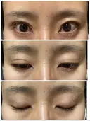 二重埋没 オジスキンクリニック BEFORE サムネイル用